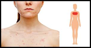 The Hidden Health Issues Related To Body Acne