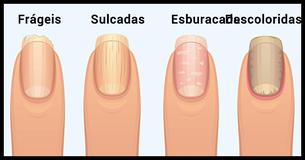 A Verdade Chocante Que As Suas Unhas Podem Revelar Sobre a Sua Saúde 