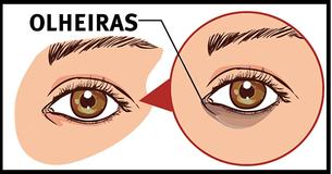 5 Métodos Naturais Para Remover Olheiras