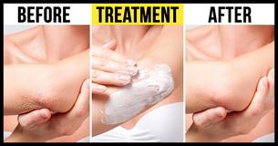 10 Natural And Inexpensive Remedies For Frustrating Skin Conditions 