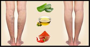 Make Varicose Veins Disappear with 10 Natural Treatments and Exercises