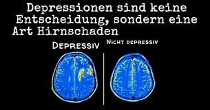 Neue Studien zeigen dass Depressionen Hirnschäden verursachen und nicht andersherum  