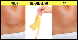 Bananenschillen: Tien Manieren Om Ze Niet Te Verspillen