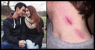 17 Jaar Oude Jongen Overlijdt Aan Een Beroerte Nadat Zijn Vriendin Hem Zuigzoenen Gaf