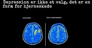 Ny research viser at depression skaber hjerne skade, ikke den anden vej rundt                                          
                                    