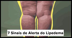 Lipedema é Geralmente Confundido com Obesidade: Fique Atenta a Estes 7 Sintomas