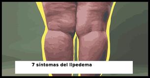 El lipedema se confunde con frecuencia con la obesidad: 7 síntomas que debes tener en cuenta                                        
                                    