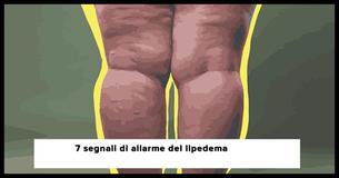 Il lipedema viene spesso confuso con l'obesità: 7 sintomi che dovesti conoscere a proposito                                        
                                    