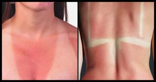 Diese 5 Symptome bedeuten, dass Dein Sonnenbrand tatsächlich Teil einer Sonnenvergiftung ist