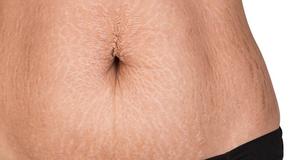 5 Natural Ways To Prevent Stretch Marks (And How To Get Rid Of Them)