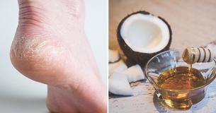5 Home Remedies For Dreaded Cracked Heels