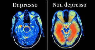 Una nuova ricerca ha collegato la depressione a un tipo specifico di danno cerebrale