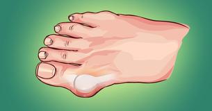 This Is How To Control A Gout Pain Attack, According To Doctors