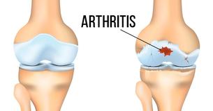 5 Foods That Help Reduce Arthritis Pain Naturally