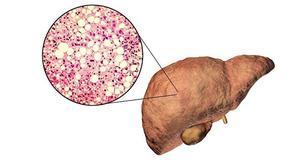 Fatty Liver Isn't Immediately Visible During Tests But These 7 Signs Are | These 7 Signs Warn Of Fatty Liver Before Tests Do | 7 Signs That Warn Of A Fatty Liver Before A Test Can Detect It