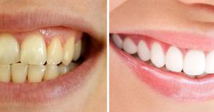 Keep Your Teeth Looking Healthy And White With These 7 Foods