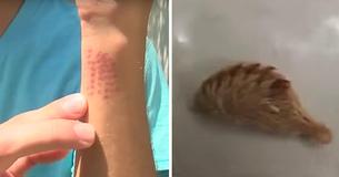This Mom Sent Out A Warning After Her Son Was Bit By A Venomous Caterpillar