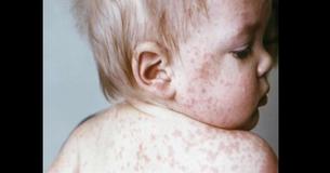 With Measles Outbreak Spreading Over 21 States, Doctors Beg Parents To Vaccinate Kids
