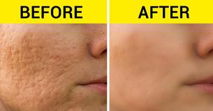 10 Hacks To Remove And Heal All Kinds Of Scars