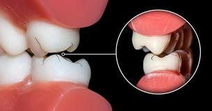 Here Is How You Can Stop Grinding Your Teeth at Night