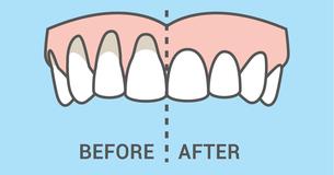 10 Simple And All-Natural Ways To Heal Receding Gums