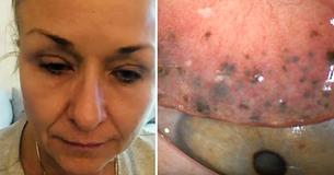 Vrouw draagt mascara naar bed voor 25 jaar, nu heeft zij oogcomplicaties. 