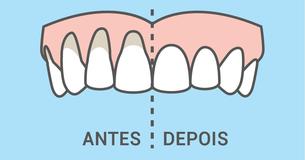 10 Maneiras Naturais de Curar a Recessão Gengival