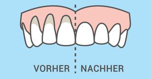 10 einfache und natürliche Wege, um Zahnfleischrezession zu heilen