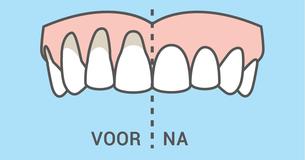 10 simpele en natuurlijke manieren om terugtrekkend tandvlees te genezen
