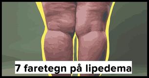 Lipedema forveksles ofte med overvægt: 7 symptomer du bør kende til
