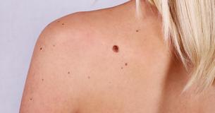 12 Natural Ways To Remove Moles, Skin Tags, And More