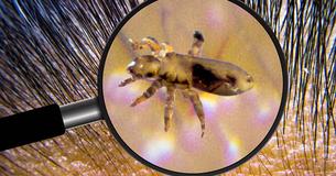 Quick and Easy Methods To Get Rid Of Lice Using Stuff You Already Have In Your Cupboard