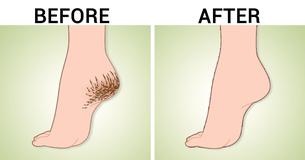 Get Rid Of Cracks, Calluses, and Corns on Your Heels With THESE Home Remedies