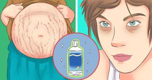 Dark Circles, Stretch Marks, And 10 Other Home Remedies You Can Make With Witch Hazel