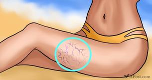 8 Natural Ways To Combat varicose Veins