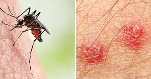 Do Your Mosquito Bites Swell and Sting? It is Possible You Have 'Skeeter Syndrome'