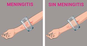 8 señales reconocibles de Meningitis