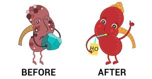 How To Naturally Flush Kidney Stones With Just Four Ingredients