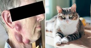 Doctors Think 68-Year-Old’s Painful Neck Boils Originated From His Cat