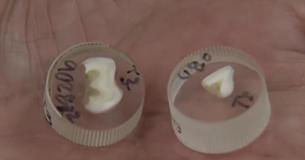 Doctors Want Parents To Keep Their Children's Baby Teeth Because They Can Predict Autism