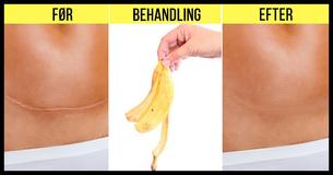 Bananskræller: Ti måder at undgå at lade dem gå til spilde på