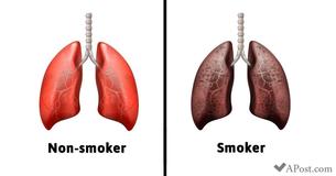 A Nurse Explains Exactly What Smoking Every Day Does To Your Lungs