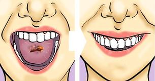 10 façons de nettoyer les taches de calcaire de vos dents