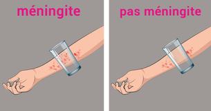 8 signes reconnaissables de méningite