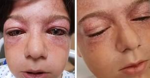 Der 11-jährige Sohn versuchte eine gefährliche "Challenge", die ihn mit schrecklichen Verletzungen zurückließ. Nun sieht er wie ein "Alien" aus. Seine Mutter warnt andere