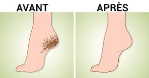 Débarrassez-vous des fissures, des callosités et des cors sur vos talons avec ces remèdes faits à la maison