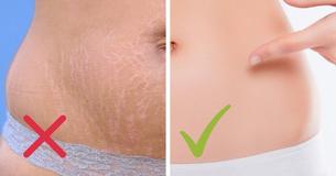 8 Natural Tips That Fade Your Stretch Marks