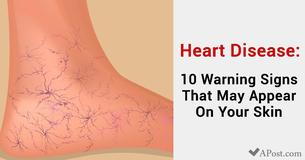 Heart Disease: 10 Warning Signs That Might Appear On Your Skin