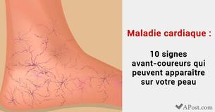 Maladie cardiaque : 10 signes avant-coureurs qui pourraient apparaître sur votre peau