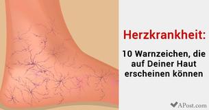 Herzkrankheit: 10 Warnzeichen, die auf Deiner Haut erscheinen könnten
